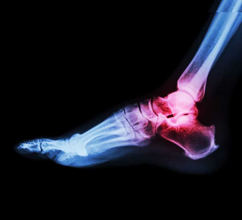 Hallux Valgus “Bunion”